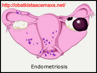 Obat Tradisional Kista Endometriosis Terbaik Masa Kini