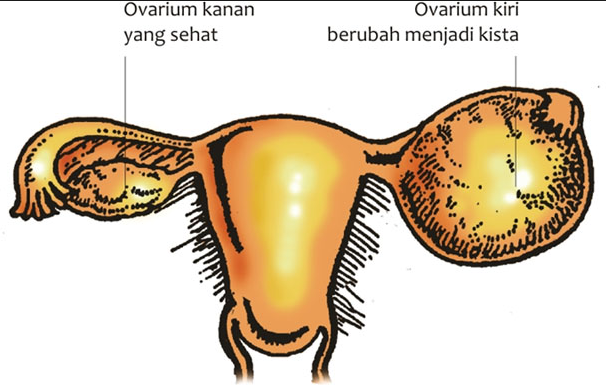 Cara Mencegah Kista Ovarium