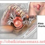 Obat Kista Ovarium