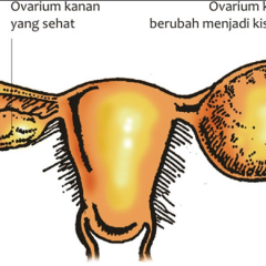 10 Cara Mencegah Kista Ovarium
